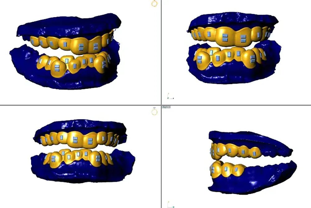 Custom Moissanite Rectangle Grillz – “Deep Frost Bite” Edition 10 upper / 10 lower - Shop Gold Supply